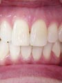 Diastema - After Diastema - After