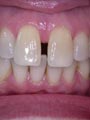Diastema - Before Diastema - Before