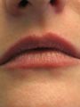Lips after treatment by Gillian M Lennox BDS MFGDP(UK)