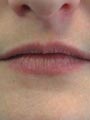Lips before treatment by Gillian M Lennox BDS MFGDP(UK)