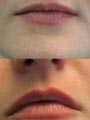Lips before/after treatment by Gillian M Lennox BDS MFGDP(UK)
