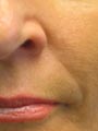 Nose to lip lines after treatment by Gillian M Lennox BDS MFGDP(UK)