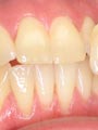 Tooth Whitening before treatment by Gillian M Lennox BDS MFGDP(UK)